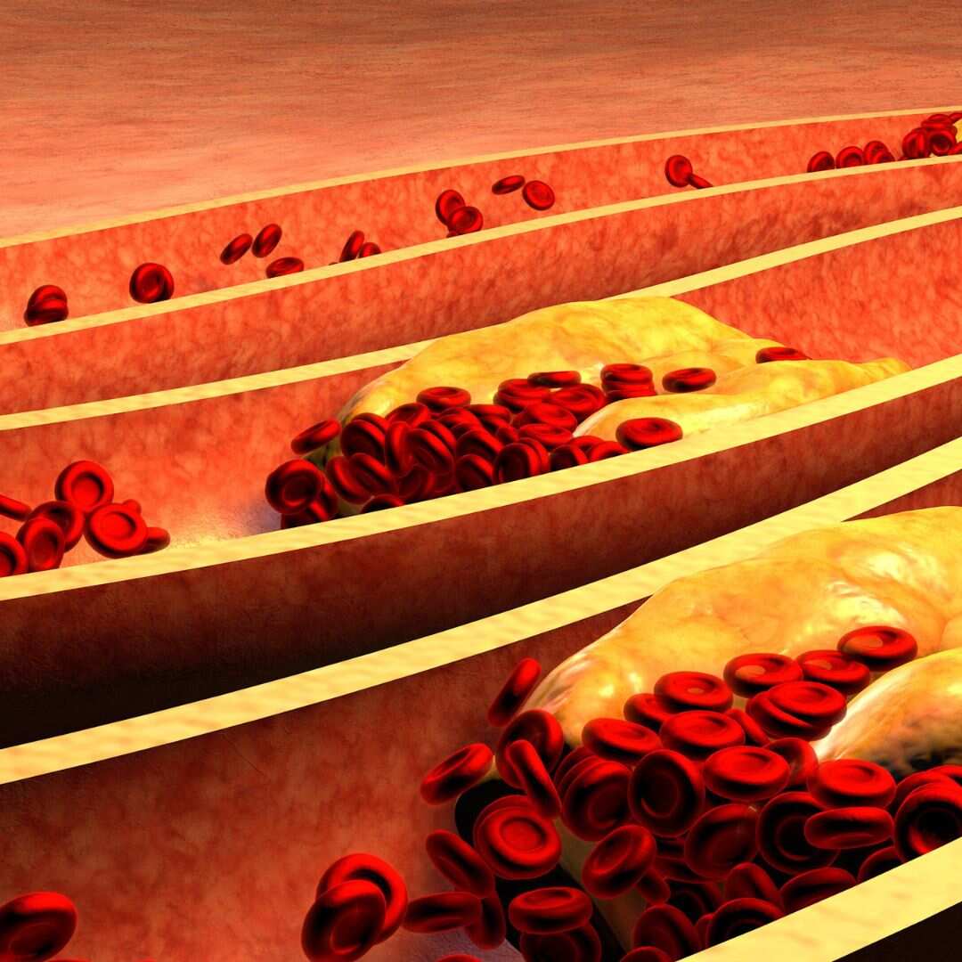 High Cholesterol Diet